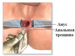 Какие основные симптомы трещины прямой кишки