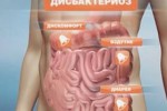 Признаки и причины возникновения дисбактериоза кишечника
